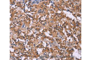 Immunohistochemistry of Human liver cancer using PIP5K1B Polyclonal Antibody at dilution of 1:30 (PIP5K1B anticorps)