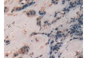 Detection of Sp100 in Human Breast cancer Tissue using Polyclonal Antibody to Sp100 Nuclear Antigen (Sp100) (SP100 anticorps  (AA 610-802))