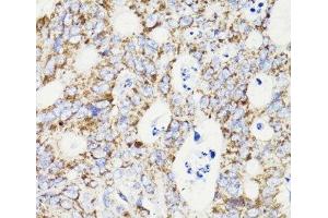 Immunohistochemistry of paraffin-embedded Human colon carcinoma using PDCD10 Polyclonal Antibody at dilution of 1:100 (40x lens). (PDCD10 anticorps)