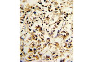 Formalin-fixed and paraffin-embedded human breast carcinoma reacted with KIR2DL4 Antibody , which was peroxidase-conjugated to the secondary antibody, followed by DAB staining. (KIR2DL4/CD158d anticorps  (C-Term))