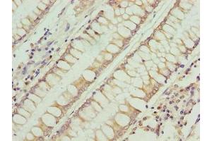 Immunohistochemistry of paraffin-embedded human colon cancer using ABIN7168228 at dilution of 1:100 (RFESD anticorps  (AA 1-157))