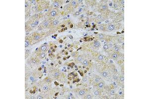 Immunohistochemistry of paraffin-embedded human liver injury using BEST1 antibody (ABIN4903043) at dilution of 1:100 (40x lens). (Bestrophin 1 anticorps)