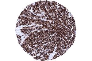 Uterus Leiomyosarcoma showing intense Caldesmon immunostaining of tumor cells Caldesmon immunohistochemistry (Recombinant Caldesmon anticorps)