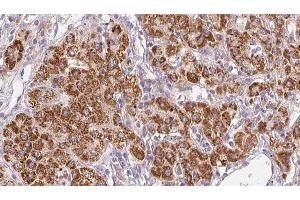 ABIN6278498 at 1/100 staining Human liver cancer tissue by IHC-P. (SLC22A6 anticorps  (Internal Region))