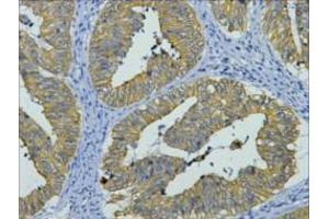 Immunohistochemistry (IHC) staining of Human Colon cancer tissue, diluted at 1:200. (KRT8 anticorps)