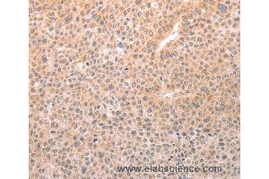 Immunohistochemistry of Human thyroid cancer using TRPC3 Polyclonal Antibody at dilution of 1:50 (TRPC3 anticorps)