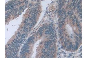 Detection of D2HGDH in Human Colorectal cancer Tissue using Polyclonal Antibody to D2-Hydroxyglutarate Dehydrogenase (D2HGDH)