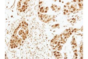 IHC-P Image Immunohistochemical analysis of paraffin-embedded human ovarian cancer, using CENPF, antibody at 1:250 dilution. (CENPF anticorps  (C-Term))
