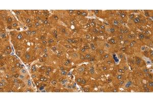 Immunohistochemistry of paraffin-embedded Human ovarian cancer tissue using SSTR3 Polyclonal Antibody at dilution 1:30