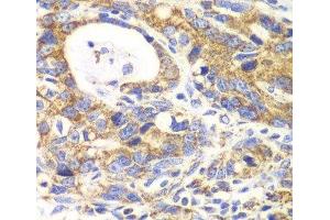 Immunohistochemistry of paraffin-embedded Human gastric cancer using GLUD2 Polyclonal Antibody at dilution of 1:100 (40x lens).