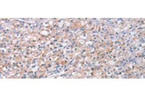 Immunohistochemistry of paraffin-embedded Human prost ate cancer tissue using STK16 Polyclonal Antibody at dilution of 1:30(x200) (STK16 anticorps)