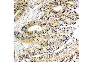 Anti-NME2 antibody, IHC(P) IHC(P): Human Intestinal Cancer Tissue (NME2 anticorps  (C-Term))
