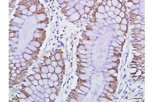 Paraformaldehyde-fixed, paraffin embedded human colon carcinoma, Antigen retrieval by boiling in sodium citrate buffer (pH6) for 15min, Block endogenous peroxidase by 3% hydrogen peroxide for 30 minutes, Blocking buffer (normal goat serum) at 37°C for 20min, Antibody incubation with GPCR EX33 Polyclonal Antibody, Unconjugated  at 1:500 overnight at 4°C, followed by a conjugated secondary and DAB staining.