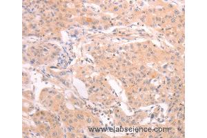 Immunohistochemistry of Human lung cancer using INA Polyclonal Antibody at dilution of 1:25 (INA anticorps)