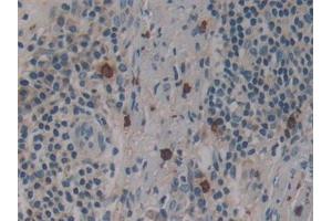 Detection of DNM2 in Human Skin cancer Tissue using Polyclonal Antibody to Dynamin 2 (DNM2)