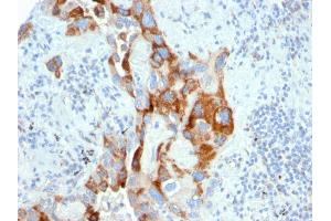Formalin-fixed, paraffin-embedded human Colon Carcinoma stained with PMEPA1 Mouse Monoclonal Antibody (PMEPA1/2696). (PMEPA1 anticorps)
