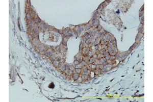 Immunoperoxidase of monoclonal antibody to F11R on formalin-fixed paraffin-embedded human breast cancer tissue.