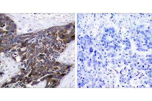 P-peptide - +Immunohistochemical analysis of paraffin-embedded human breast carcinoma tissue, using Connexin43 (Phospho-Ser367) antibody. (Connexin 43/GJA1 anticorps  (pSer367))