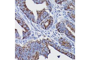 Immunohistochemistry of paraffin-embedded human colon carcinoma using Clusterin alpha chain Rabbit pAb (ABIN6133477, ABIN6138756, ABIN6138758 and ABIN6216721) at dilution of 1:100 (40x lens). (Clusterin anticorps  (AA 23-120))