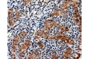 Immunohistochemical staining of paraffin-embedded Adenocarcinoma of ovary tissue using anti-LIPG mouse monoclonal antibody. (LIPG anticorps)