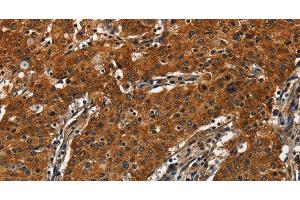 Immunohistochemistry of paraffin-embedded Human gastric cancer tissue using CATSPER4 Polyclonal Antibody at dilution 1:50 (CATSPER4 anticorps)