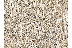 FER Mouse Monoclonal Antibody at 1/100 staining human gastric cancer by IHC-P. (FER anticorps)