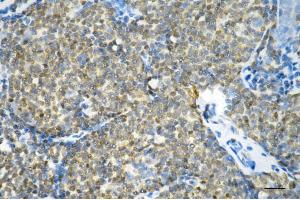 Immunohistochemistry was performed on paraffin-embedded human breast carcinoma using glutathione-disulfide reductase antibody (ABIN7798754), 1:200). (Recombinant Glutathione Reductase anticorps)