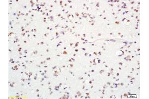 Formalin-fixed and paraffin embedded human glioma labeled with Anti-MASH1/ASCL1 Polyclonal Antibody, Unconjugated (ABIN738471) at 1:200 followed by conjugation to the secondary antibody and DAB staining (ASCL1 anticorps  (AA 151-236))