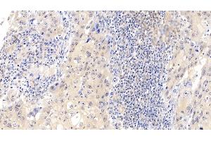 Detection of CDK4 in Human Lymphoma Tissue using Polyclonal Antibody to Cyclin Dependent Kinase 4 (CDK4)