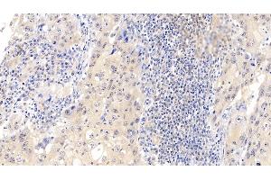 Detection of CDK4 in Human Lymphoma Tissue using Polyclonal Antibody to Cyclin Dependent Kinase 4 (CDK4) (CDK4 anticorps  (AA 6-295))