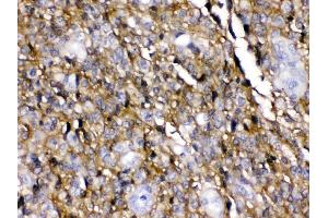 EAAT1 was detected in paraffin-embedded sections of huaman glioma tissues using rabbit anti- EAAT1 Antigen Affinity purified polyclonal antibody (Catalog # ) at 1 µg/mL.