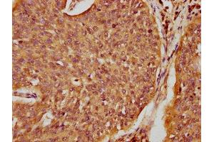 IHC image of ABIN7168929 diluted at 1:100 and staining in paraffin-embedded human cervical cancer performed on a Leica BondTM system.