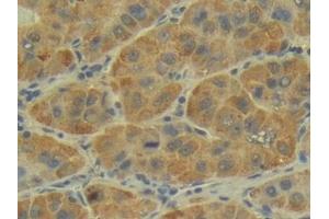 Detection of P-cadherin in Human Liver cancer Tissue using Polyclonal Antibody to Placental Cadherin (P-cadherin)