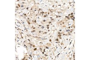 Immunohistochemistry of paraffin-embedded human breast cancer using CDK12 Rabbit pAb (ABIN7266230) at dilution of 1:500 (40x lens).