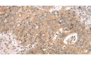 Immunohistochemistry of paraffin-embedded Human breast cancer using STX10 Polyclonal Antibody at dilution of 1:45 (Syntaxin 10 anticorps)
