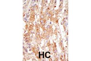 Formalin-fixed and paraffin-embedded human hepatocellular carcinoma tissue reacted with the MAP3K6 polyclonal antibody  , which was peroxidase-conjugated to the secondary antibody, followed by DAB staining. (MAP3K6 anticorps  (C-Term))