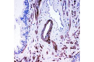 Anti- ACE antibody,  IHC(P) IHC(P): Human Prostatic Cancer Tissue (Angiotensin I Converting Enzyme 1 anticorps  (Middle Region))
