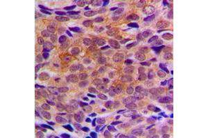 Immunohistochemical analysis of ARFIP1 staining in human breast cancer formalin fixed paraffin embedded tissue section. (ARFIP1 anticorps  (C-Term))