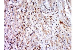Paraformaldehyde-fixed, paraffin embedded human cervical cancer, Antigen retrieval by boiling in sodium citrate buffer (pH6) for 15min, Block endogenous peroxidase by 3% hydrogen peroxide for 30 minutes, Blocking buffer (normal goat serum) at 37°C for 20min, Antibody incubation with MFAP1 Polyclonal Antibody, Unconjugated  at 1:500 overnight at 4°C, followed by a conjugated secondary and DAB staining