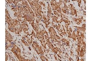 ABIN6267311 at 1/50 staining human breast cancer tissue sections by IHC-P.