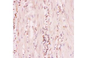 Anti-MRP4 Picoband antibody,  IHC(P): Human Intestinal Cancer Tissue (ABCC4 anticorps  (AA 1-370))