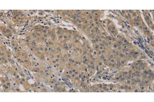 Immunohistochemistry of paraffin-embedded Human gastric cancer tissue using AGTRAP Polyclonal Antibody at dilution 1:40 (AGTRAP anticorps)