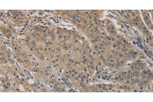 Immunohistochemistry of paraffin-embedded Human gastric cancer tissue using AGTRAP Polyclonal Antibody at dilution 1:40