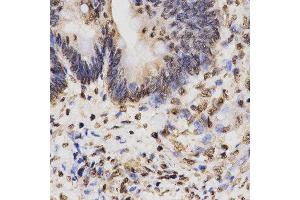 Immunohistochemistry of paraffin-embedded human rectal cancer tissue using H3K27me3 antibody at dilution of 1:200 (x400 lens). (Histone 3 anticorps  (H3K27me))