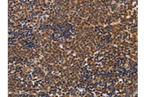 The image on the left is immunohistochemistry of paraffin-embedded Human lymphoma tissue using ABIN7128260(ADH1A Antibody) at dilution 1/20, on the right is treated with fusion protein.