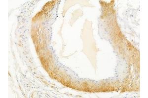 ABIN6259746 and ABIN6268898 at 1/100 staining human testicular cancer by IHC-P.