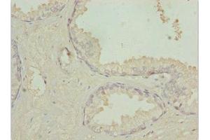 Immunohistochemistry of paraffin-embedded human prostate cancer using ABIN7172947 at dilution of 1:100 (TM9SF1 anticorps  (AA 28-230))