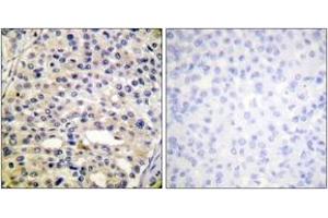Immunohistochemistry analysis of paraffin-embedded human breast carcinoma, using Vimentin (Phospho-Ser56) Antibody. (Vimentin anticorps  (pSer56))
