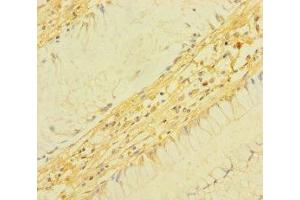 Immunohistochemistry of paraffin-embedded human colon cancer using ABIN7172934 at dilution of 1:100 (TM4SF5 anticorps  (AA 112-157))