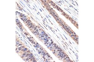 Immunohistochemistry of paraffin-embedded human colon carcinoma using sestrin 1 Rabbit mAb (ABIN7270259) at dilution of 1:100 (40x lens). (SESN1 anticorps)
